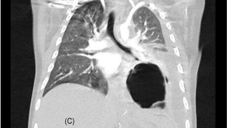 El síndrome inflamatorio multisistémico puede ser mucho más peligroso si se complementa con el coronavirus.