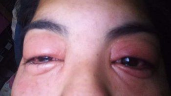 Hizo un curso de extensión de pestañas y quedó con los ojos heridos