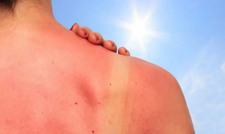 Extremar cuidados en el verano es clave para prevenir el cáncer de piel más agresivo