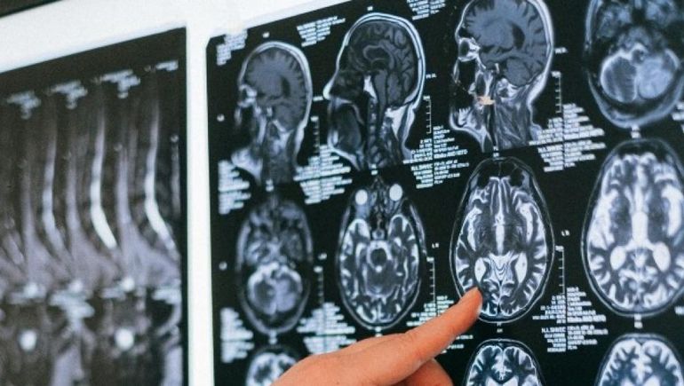 El Parkinson afecta a 9 millones de personas (y serán más)