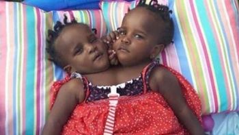 son siamesas, tienen 4 anos y su futuro es muy dificil son siamesas, tienen 4 anos y su futuro es muy dificil