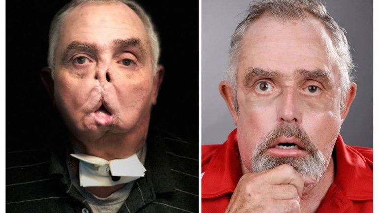 A los 64 años le hicieron un trasplante de cara con éxito