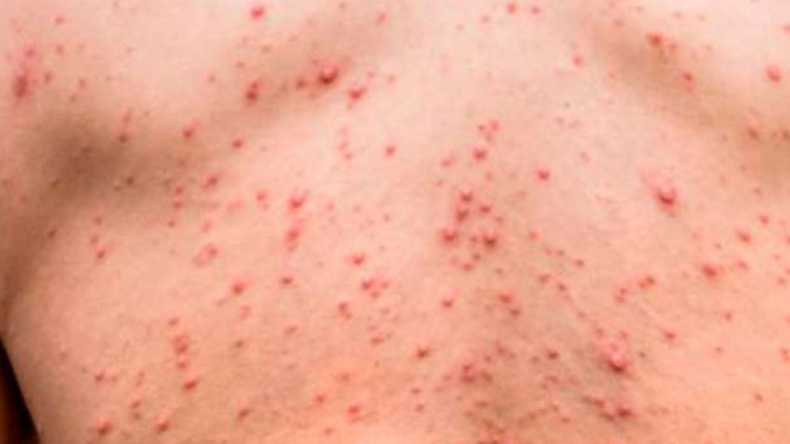 El sífilis es una enfermedad que, si no se trata, puede causar graves consecuencias. | LM Neuquen El sífilis es una enfermedad que, si no se trata, puede causar graves consecuencias.