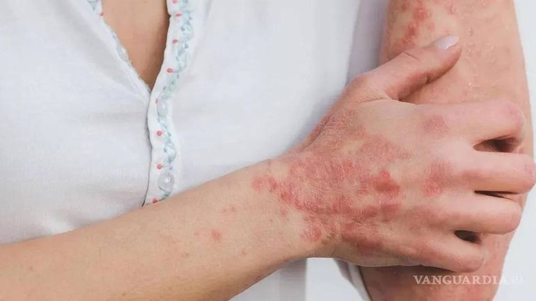 28 estados de México registran 300 contagiados de Lepra. 28 estados de México registran 300 contagiados de Lepra.