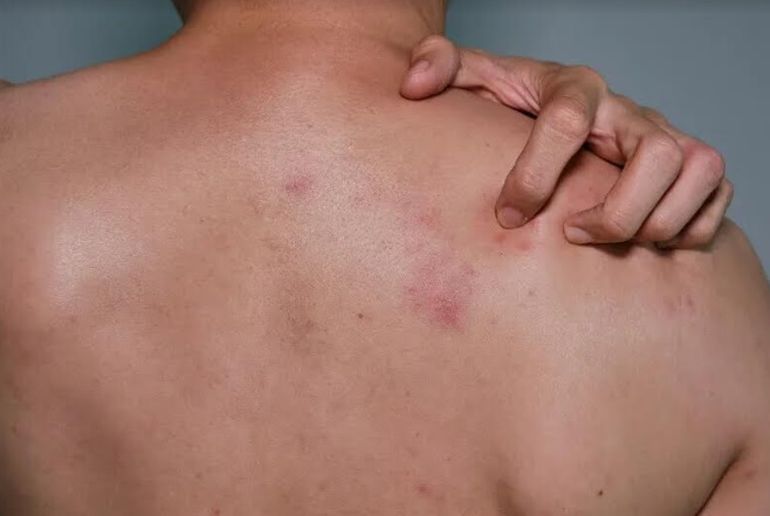 El Ministerio de Salud de la Nación reconoció la Histaminosis, una enfermedad poco frecuente. El Ministerio de Salud de la Nación reconoció la Histaminosis, una enfermedad poco frecuente.