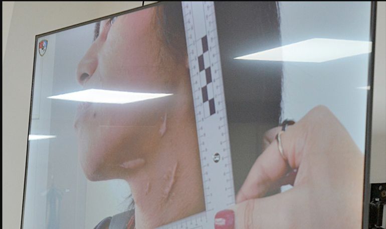 Las cicatrices que le dejó a Lautaro el brutal ataque de su primo, con quien tenía una relación íntima que había originado una venganza orquestada por la novia. Las cicatrices que le dejó a Lautaro el brutal ataque de su primo, con quien tenía una relación íntima que había originado una venganza orquestada por la novia.