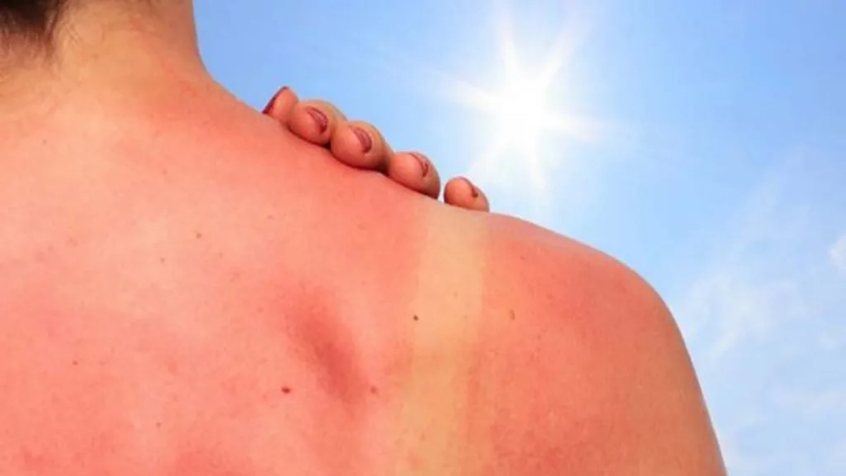 Extremar cuidados en el verano es clave para prevenir el cáncer de piel más agresivo thumbnail