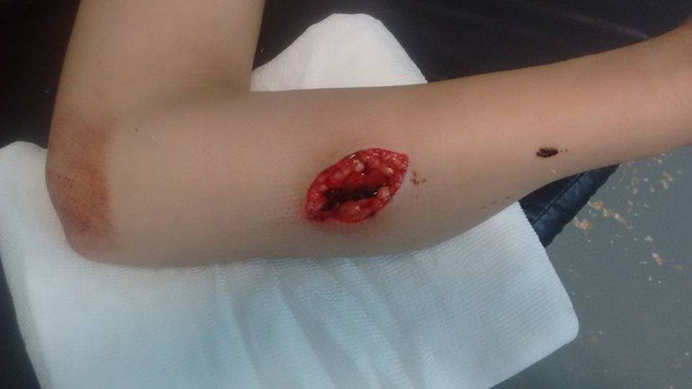 La chica mostró por Facebook la tremenda herida en el brazo izquierdo.
