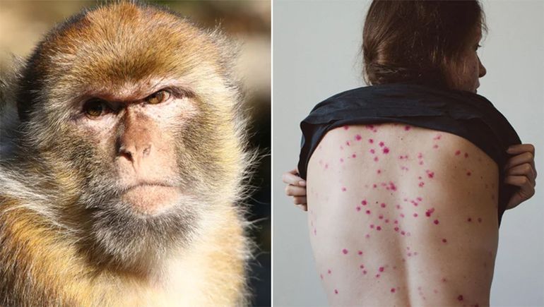 Alerta: segundo caso sospechoso de viruela del mono en Argentina