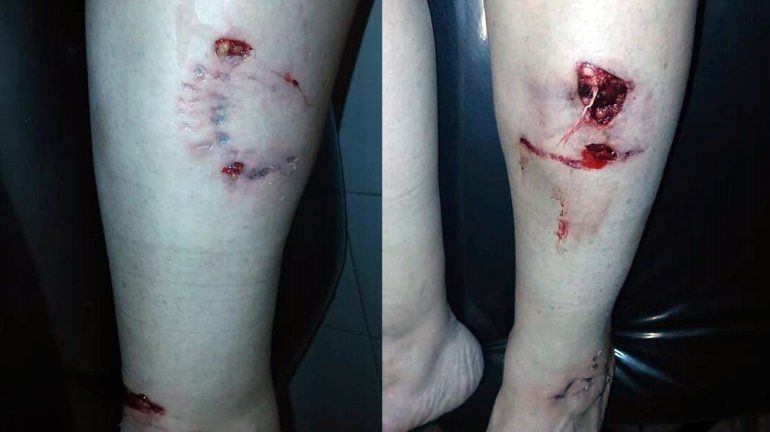 Salió de la casa de una amiga y un pitbull la atacó por atrás: sufrió heridas de gravedad