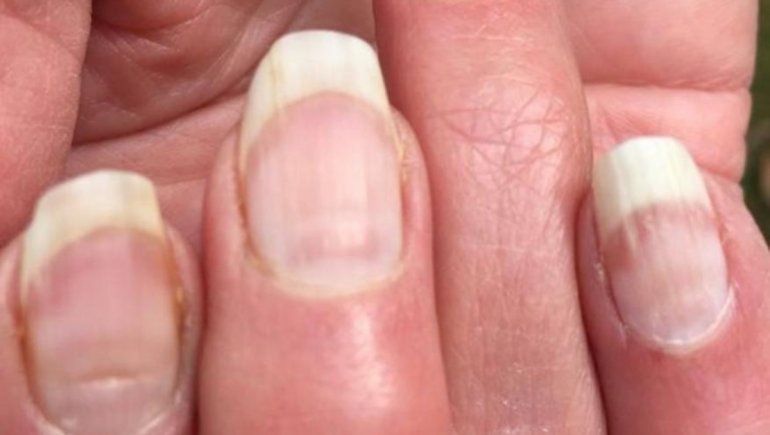 ¿Cómo saber si ya tuve covid-19?