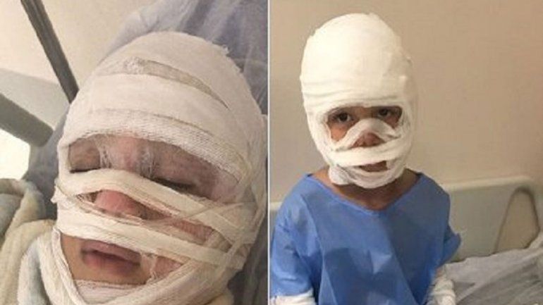 Desgarrador: nene se quemó y le pide una cara a Papá Noel