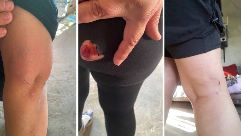 La peor lesión la sufrió en la zona de los glúteos. 