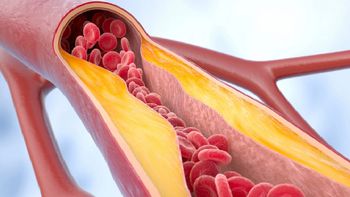 Los accidentes cerebrovasculares (ACV) e infartos son las principales causas de muerte en el mundo. Los accidentes cerebrovasculares (ACV) e infartos son las principales causas de muerte en el mundo.