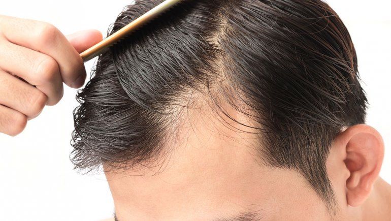 Abre una nueva sucursal de Hair Recovery en Neuquén, ahora la recuperación capilar tiene cobertura en la Patagonia Sur