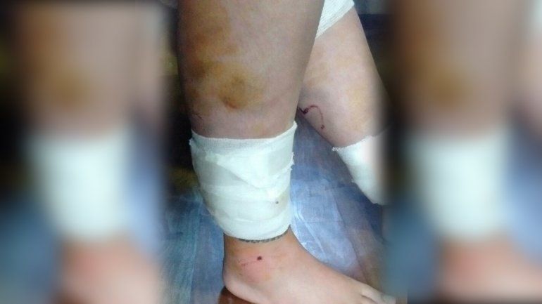 Salió en bici, la atacaron diez perros y tuvo que ser operada