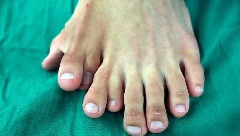 Un joven chino tenía nueve dedos en un pie