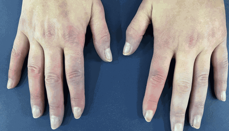 El síndrome de Raynaud es la primer señal. El síndrome de Raynaud es la primer señal.