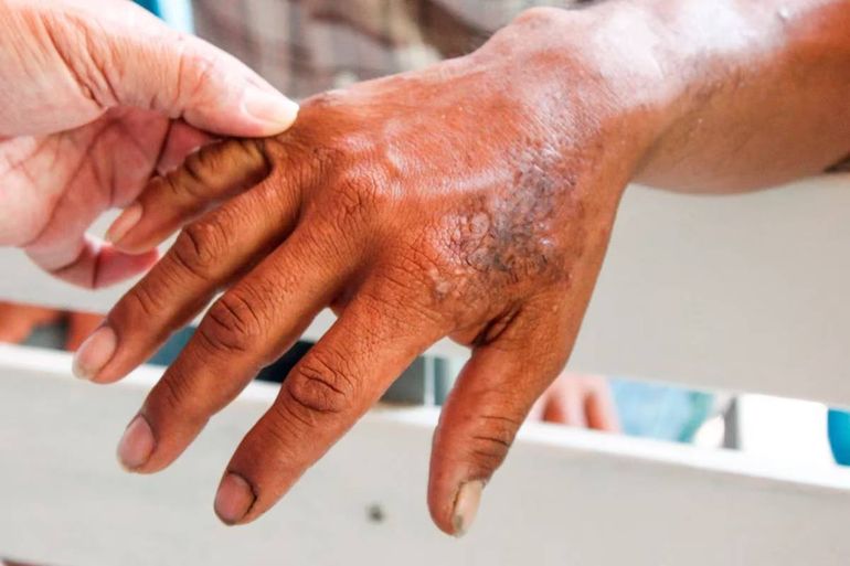 México en alerta por el aumento de casos de Lepra