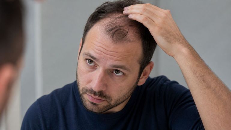 La caída del pelo aparece como un posible efecto en personas que usan inyecciones para adelgazar.