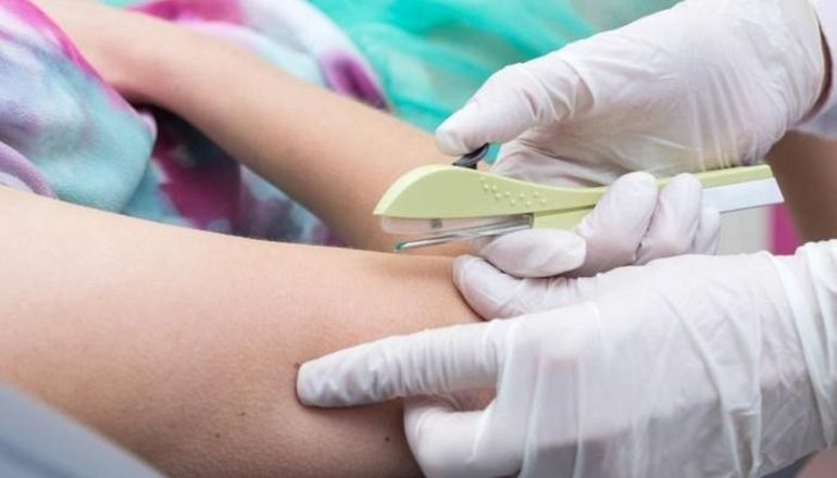El implante subdérmico se impone como método anticonceptivo en Neuquén
