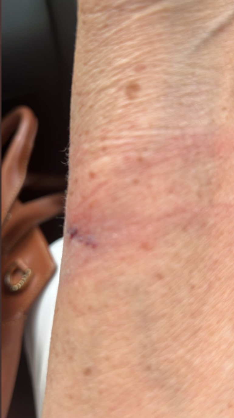 La imagen del moretón que le quedó a la periodista en el brazo fue difundida por el Pampito.