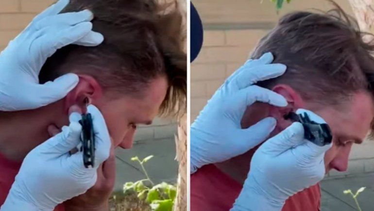 Viral: le revisaron la oreja y tenía una enorme abeja en el interior.