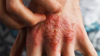 Nuevos tratamientos traen alivio a los que padecen dermatitis atópica severa