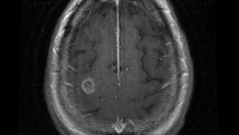 La ameba comecerebros amenaza al mundo