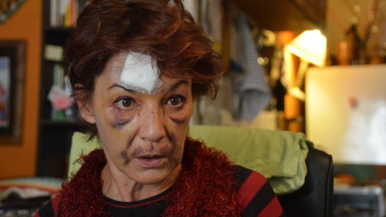 El rostro de Diana es la prueba de la violencia con la que actuó el motochorro.