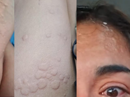 Una joven fue picada por una chaqueta amarilla y documentó toda la reacción que le provocó. Una joven fue picada por una chaqueta amarilla y documentó toda la reacción que le provocó.