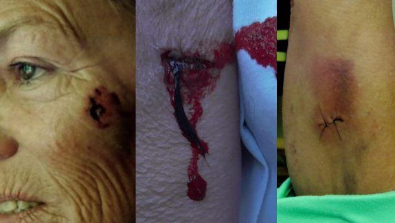 Una mujer fue brutalmente atacada por dos perros de su vecina