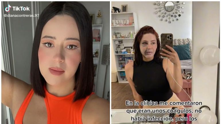 Tiktoker se hizo una bichectomía y quedó desfigurada: Que les sirva de ejemplo