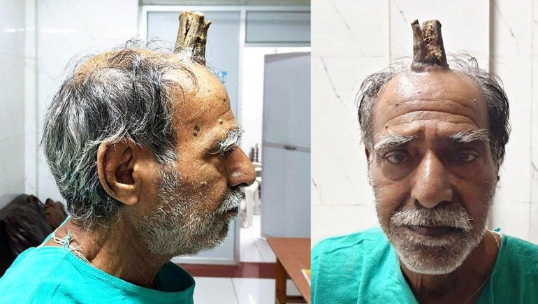 India: a un granjero le extirparon el cuerno del diablo
