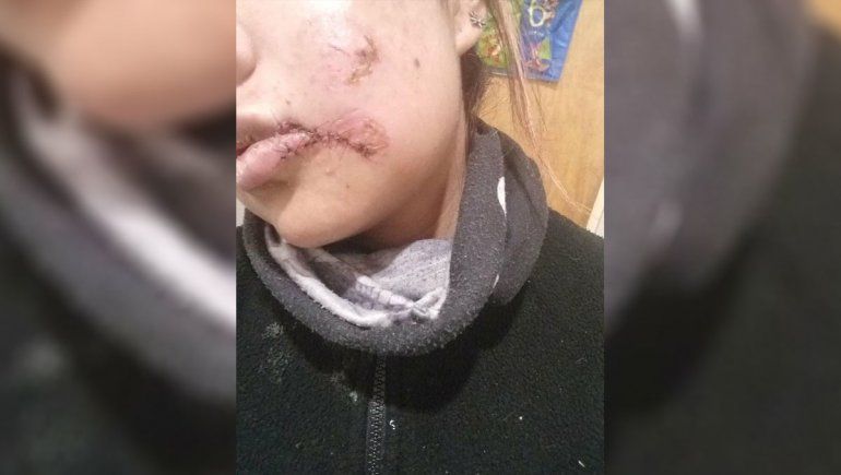 Brutal: atacó a su novia y le arrancó parte del labio
