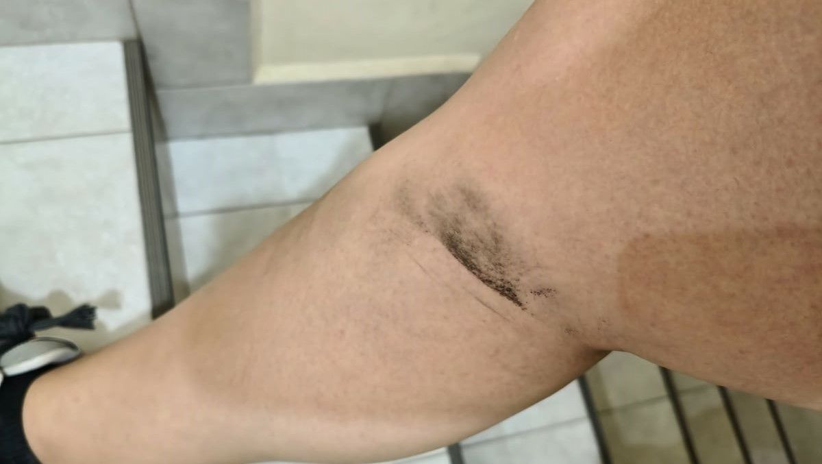 La marca que le quedó a la vecina que denunció que un agente de tránsito en Cipolletti