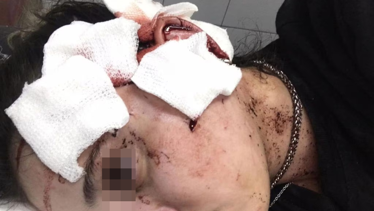 Desfiguró con un vaso a una moza