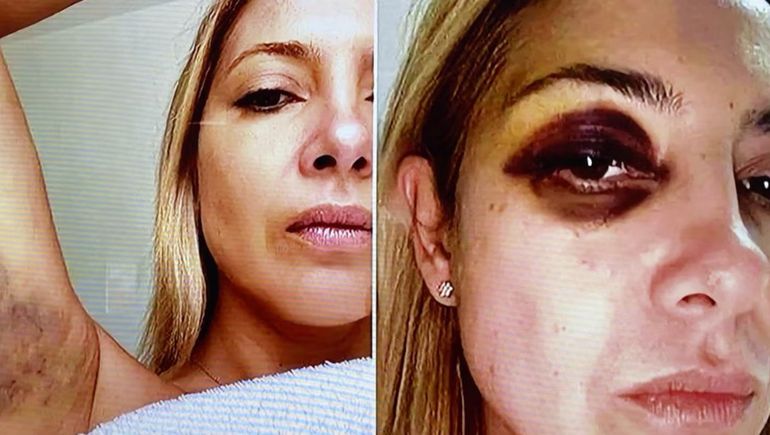 Las fotos de Fabiola Yañez golpeada por Alberto Fernández Las fotos de Fabiola Yañez golpeada por Alberto Fernández