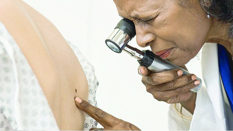 Melanoma: es el cáncer de piel menos frecuente y más preocupante.