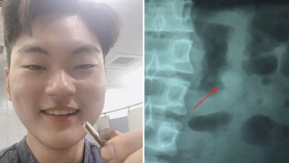 Se tragó un auricular y escuchó los sonidos que hace su estómago