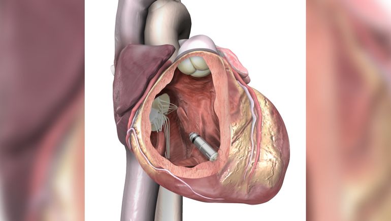 Implantan un marcapasos del tamaño de una píldora