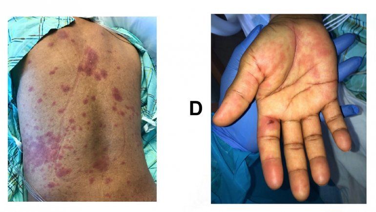 Coronavirus podría causar el síndrome inflamatorio multisistémico en niños