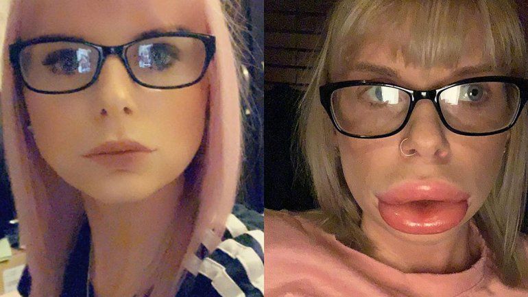 Se inyectó botox en los labios y casi se muere