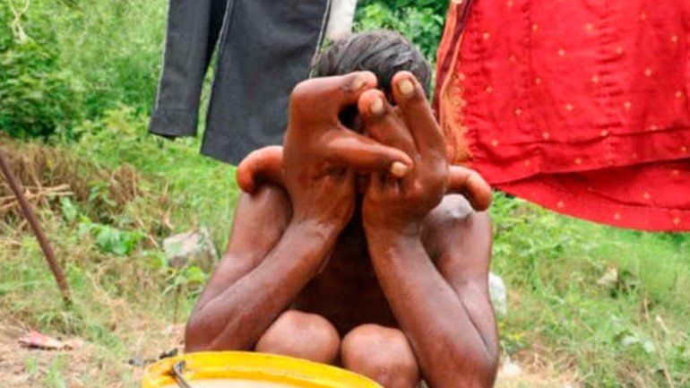 En la India un nene de 12 años tiene manos de elefante