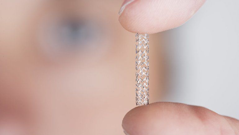 Qué es un stent y en qué ocasiones se debe colocar
