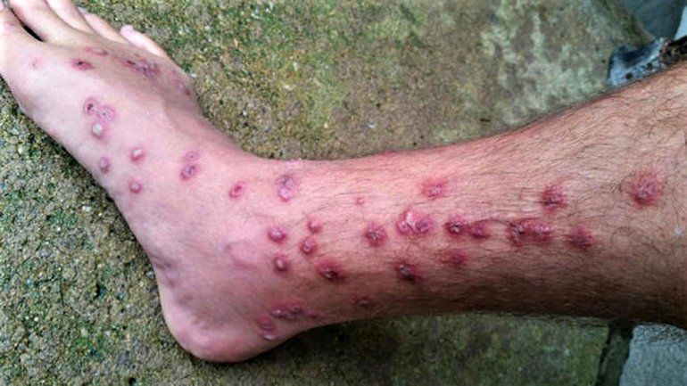 Alerta por el incremento de ataques de piojo de pato en lagos de la región