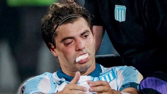Cómo le quedó el rostro a Santiago Sosa luego de la operación por la fractura que le hizo Marcos Rojo