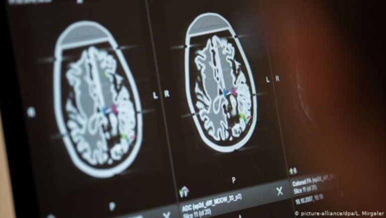 Covid-19: estudio asegura que la enfermedad reduce la materia gris en una parte del cerebro