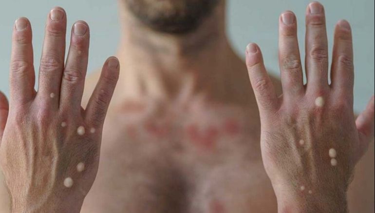 El caso de esta variante de viruela se informó en el Boletín Epidemiológico.