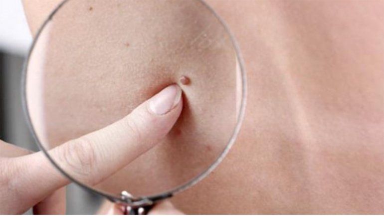 Comenzó el chequeo de lunares para prevenir cáncer de piel